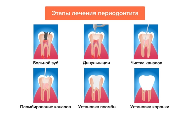 etapy periodontita.jpg